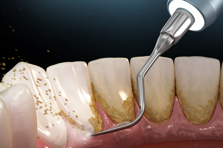 Ce este detartrajul dentar si cat costa?